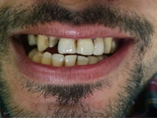 Before installing Tooth Cap, Crowns, Bridges | Dental Sphere