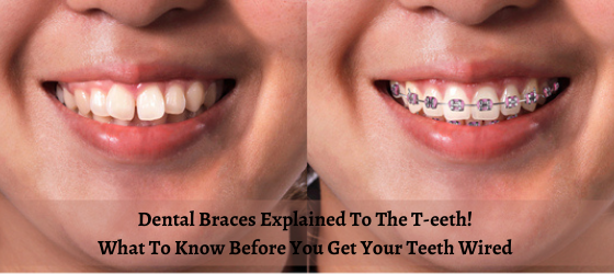 Dental-Braces-Explained-To-The-T-eeth-What-To-Know-Before-You-Get-Your-Teeth-Wired-1.png